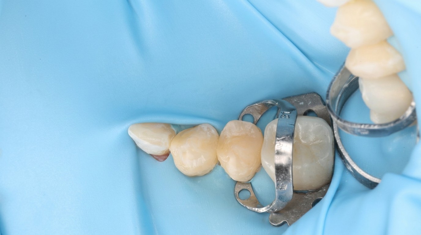 A row of completed tooth-colored composite restorations on natural posterior teeth, isolated under a blue rubber dam.