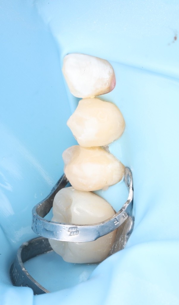 Vertical stack of four restored teeth, the lowest still wrapped in a metal matrix band before final cure.