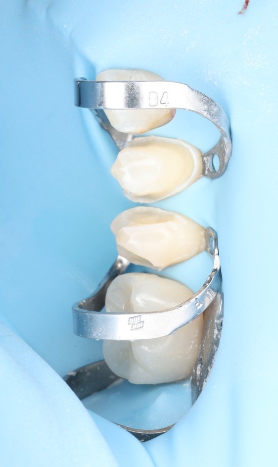 Two pairs of posterior teeth with sectional matrix bands and clamps in place, isolated by a blue dental dam.