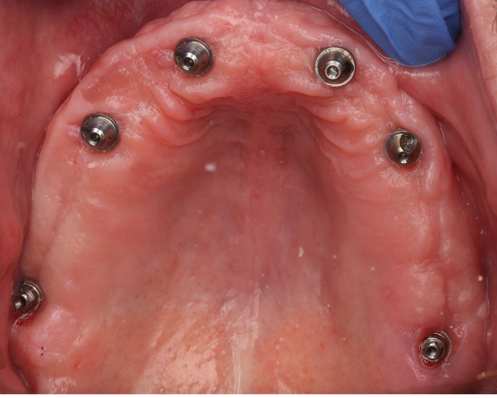 Top-down view showing healed implant abutments.