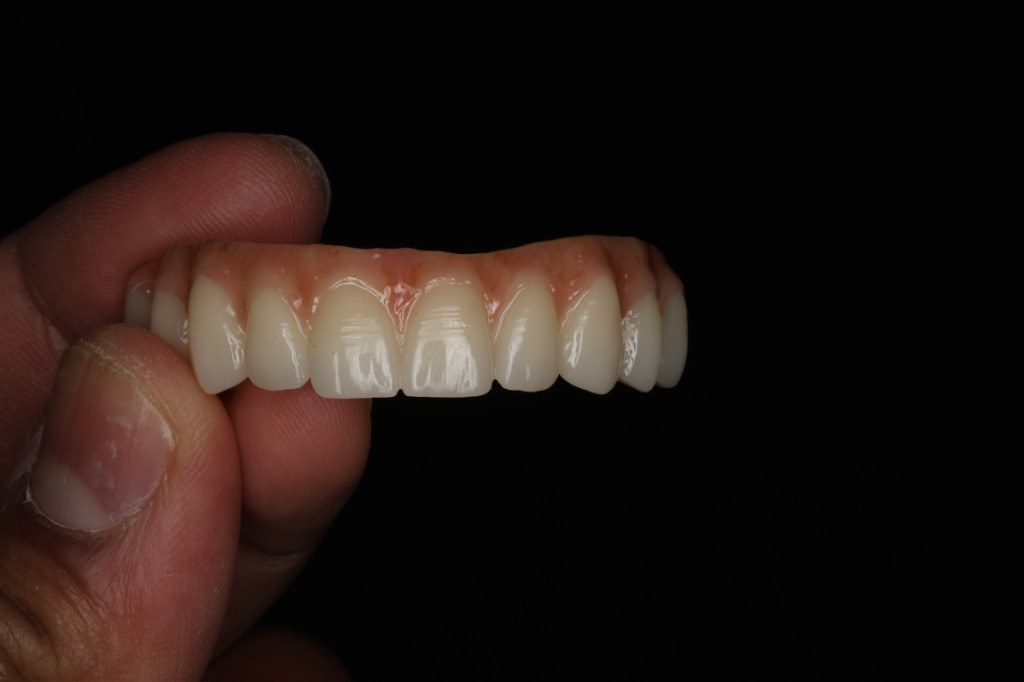 Close detail of the finished implant prosthesis.