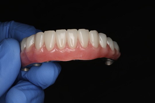 Implant prosthesis held in a gloved hand.