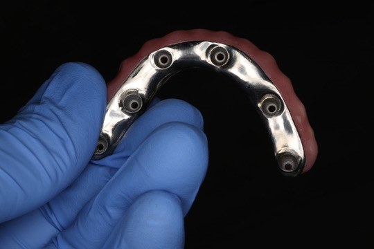 Underside of the prosthesis showing the metal framework and multi-implant connections.
