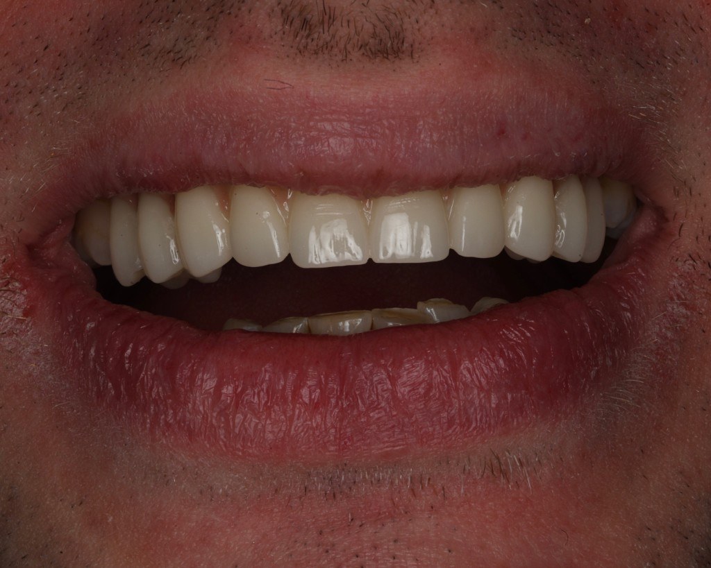 Close-up smile after full-mouth implant restoration.