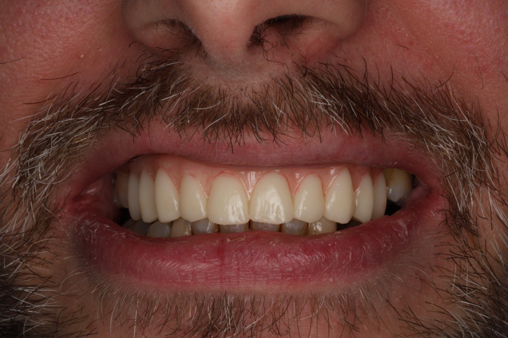 Patient smile after full-mouth implant restoration, natural light.