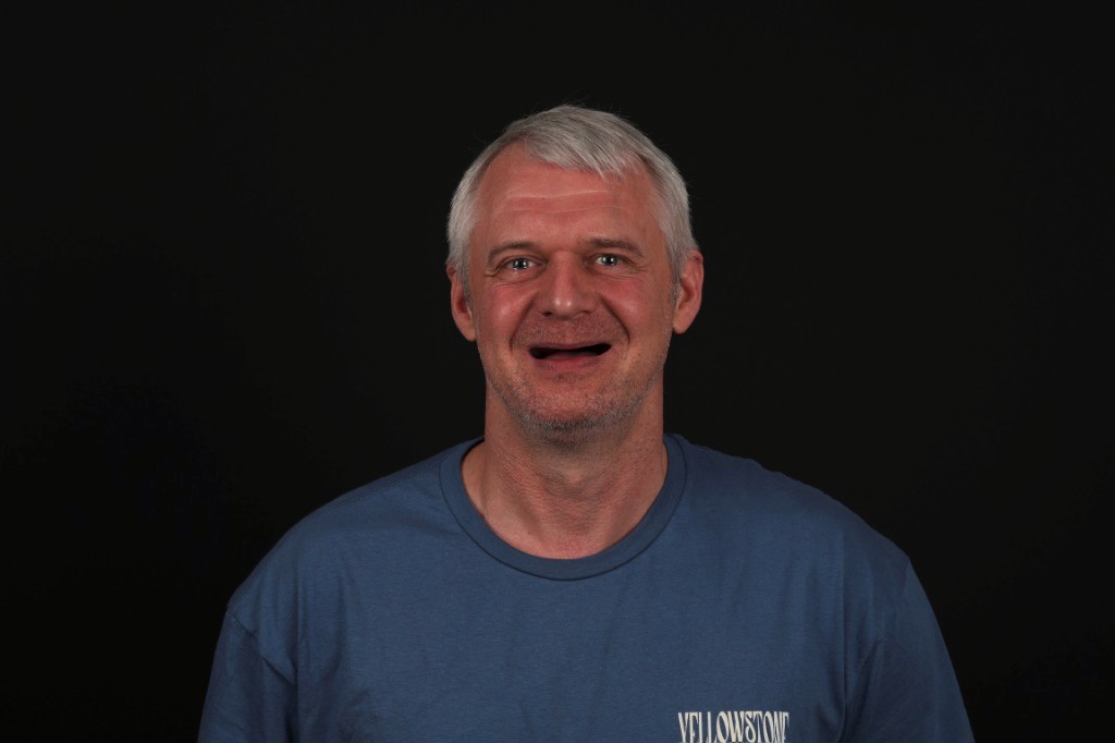 Before full implant treatment.