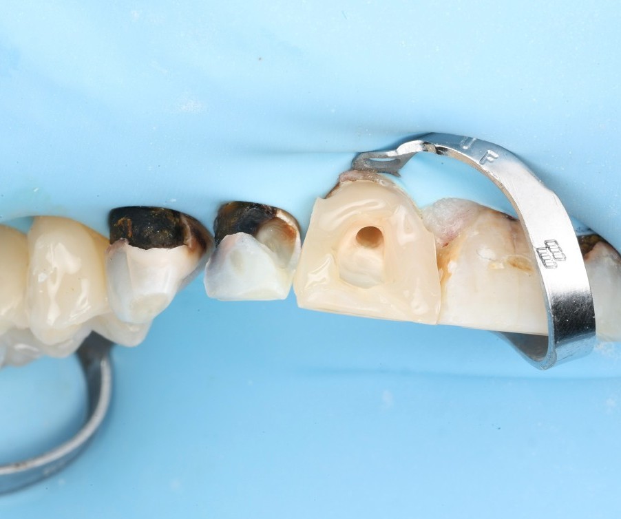 Mid-treatment access cavities, broken-down crowns isolated under a rubber dam.