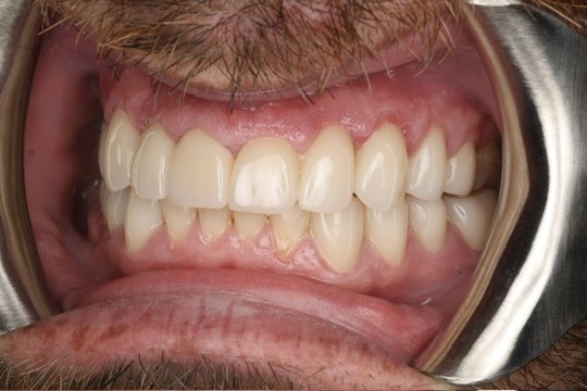 The patient today — post-op view of the restored teeth and crowns.