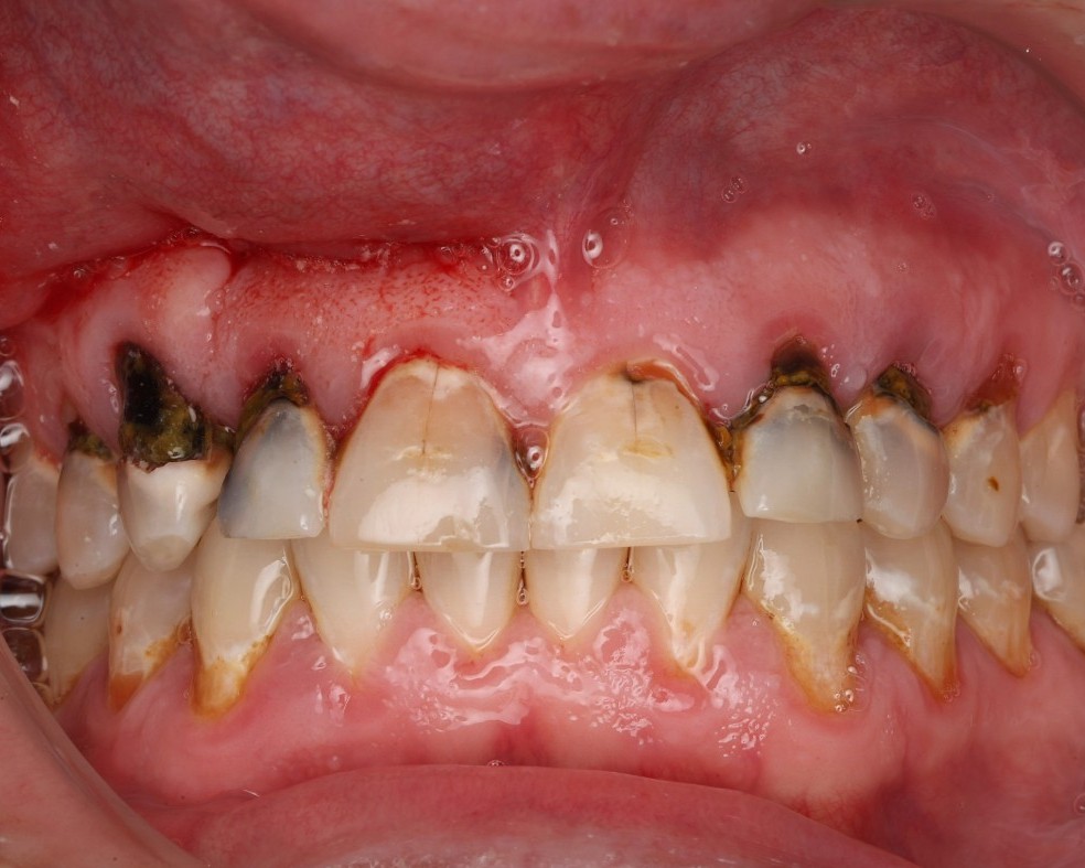 Pre-op intraoral view — multiple teeth with severe decay and inflamed gums.