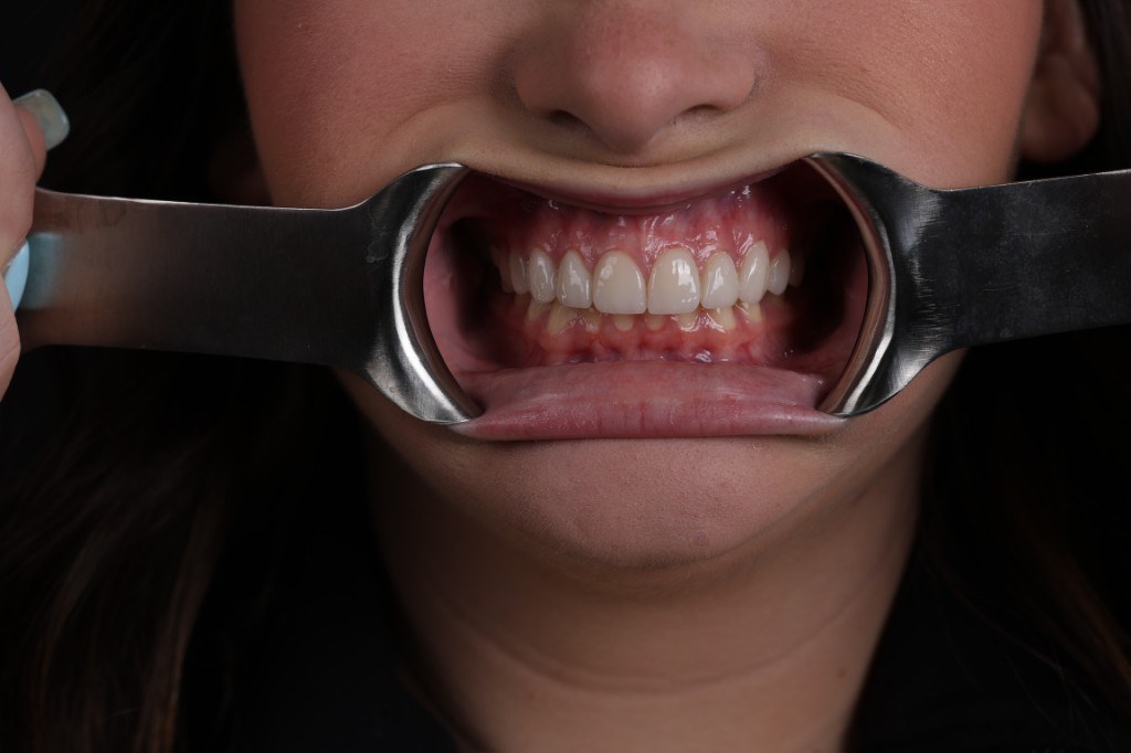 Final smile shown with a retractor — full upper and lower teeth visible.