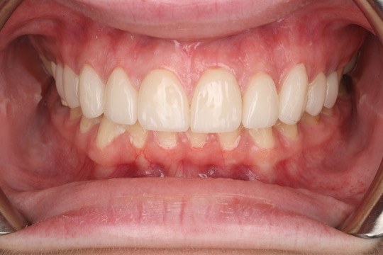 Close-up of the final smile after veneer placement.