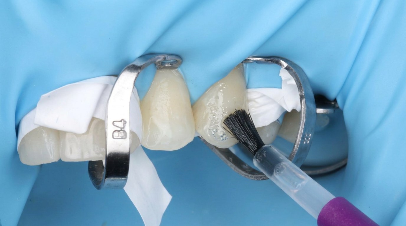 Bonding agent being applied to prepared front teeth with a small brush.
